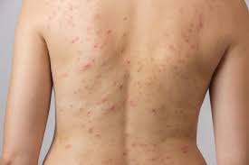 Mụn lưng nỗi ám ảnh của chị em 