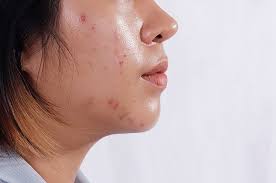 Da dầu nhờn gây mụn 