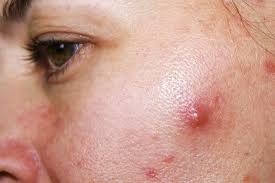 Để trị mụn bạn cần chăm sóc phần da bị mụn mỗi ngày