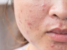 Điều trị mụn như thế nào?