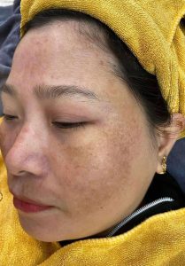 3 Phương Pháp Trị Nám Da Tại Nhà Hiệu Quả Từ Thiên Nhiên