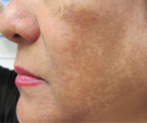 5 Thói Quen Hàng Ngày Khiến Nám Da Nghiêm Trọng Hơn