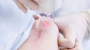 3''Bí Mật'' Những điều cần biết trong laser điều trị sẹo mà không phải ai cũng biết?