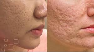 7 Phương Pháp Điều Trị Sẹo Hiện Đại Nhất Hiện Nay