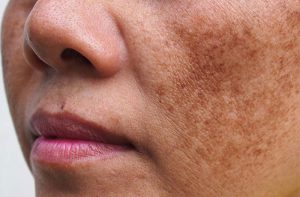 cơ chế hình thành nám để phòng ngừa