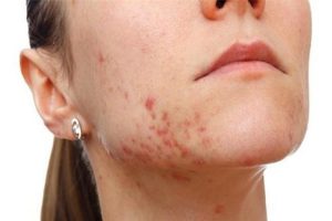 Điều trị mụn ở dưới cổ đúng cách hiệu quả không gây thâm sẹo