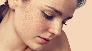 7 Cách Trị Tàn Nhang Hiệu Quả Bạn Nên Biết