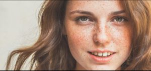 Tàn nhang là gì? Nguyên nhân và 3 cách điều trị hiệu quả