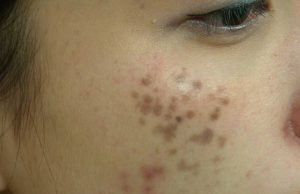 Nám chân sâu là gì?